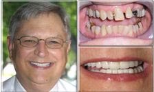 Missing and Misaligned Teeth