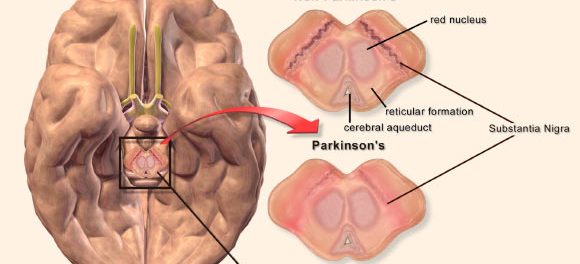 Parkinsons-Disease