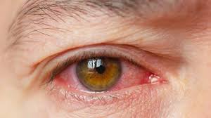 Dry Eye Syndrome (DES) Treatment Market