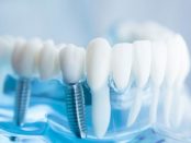 Dental Biomaterials Market