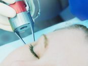 Aesthetic/Cosmetic Lasers Market