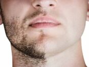 beard transplant cost- Beverly Hills Release a New Post on Beard Hair Transplant