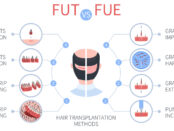 fue vs fut- Beverly Hair Restoration Updates Blog on Comparison Between FUT vs. FUE