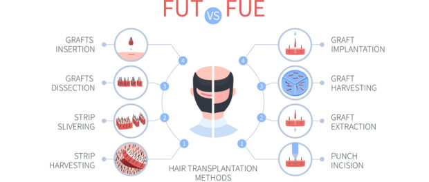 fue vs fut- Beverly Hair Restoration Updates Blog on Comparison Between FUT vs. FUE