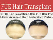 FUE hair transplant- Beverly Hills Hair Restoration Offers FUE Hair Transplant with their Advanced Hair Restoration Techniques