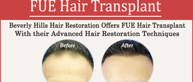 FUE hair transplant- Beverly Hills Hair Restoration Offers FUE Hair Transplant with their Advanced Hair Restoration Techniques