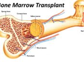 Bone Marrow Transplant Cost