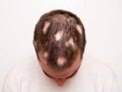 Alopecia areata- Beverly Hills Hair Transplant Release a new post on alopecia areata with the Latest & Best Hair Treatments