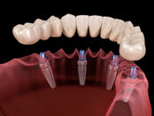 Dental Implants Livingston