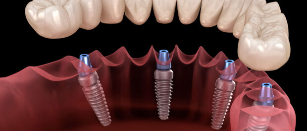 Dental Implants Livingston