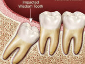 Dental Implants Livingston