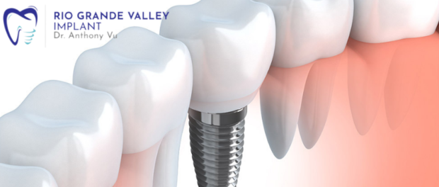 Dental Implant