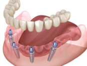All-On-4 Dental Implants in Houston