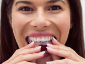 Invisalign in Delray