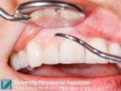 Periodontal Treatment Houston