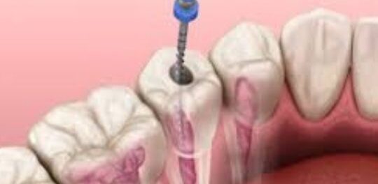 Root Canal Therapy Magnolia