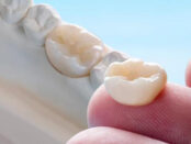 Dental Crowns Scottsdale