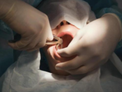 Tooth Extraction in Sharpsville