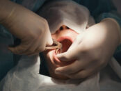 Dental Implants in Artesia