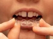 Invisalign First