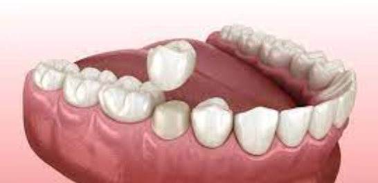 Dental Restoration Services