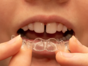 Invisalign for teens