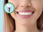 dental implants Rio Rancho