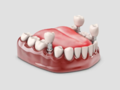 Dental Bridges