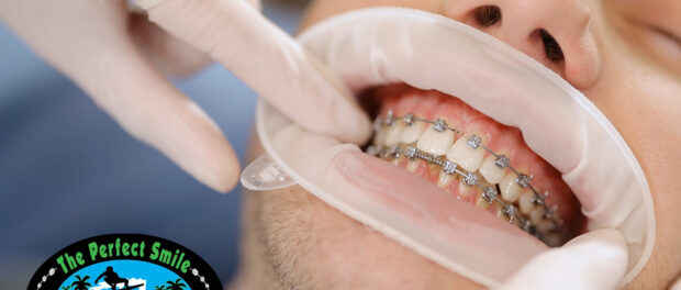 Early Orthodontics Treatment in Arlington