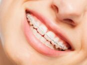 Ceramic-Clear-Braces