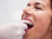 Invisalign-Treatment