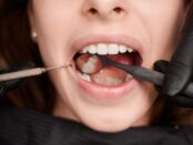 Dental Fillings