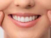 Teeth Whitening Treatment Ardmore