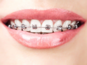 Braces in Hewlett