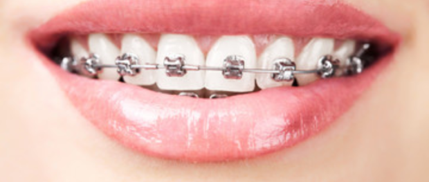 Braces in Hewlett