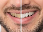 Teeth Whitening Salt Lake City