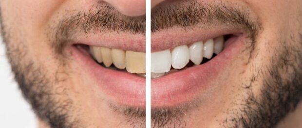 Teeth Whitening Salt Lake City