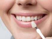 Dental Veneers in cosmetic dentistry