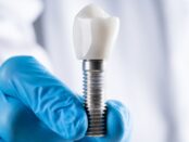 free dental implant consultation in broken arrow