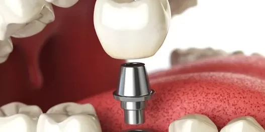 Dental Implant Surgery