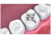 dental sealants at Crossroads Dental of Victoria in victoria