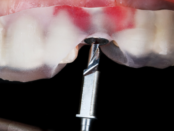 no drill restoration at gilreath family dentistry in marietta