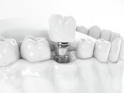 Dental Implant in Queens