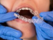 Invisalign Treatment in Beverly Hills