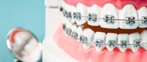 Braces in The Woodlands