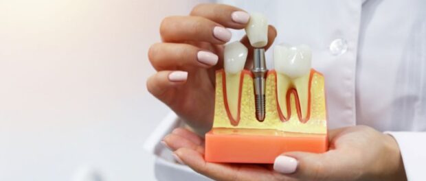 dental implant boynton beach