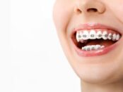 Dental Braces in Prairie Village