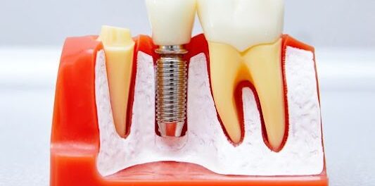 Dental Implant Phoenix