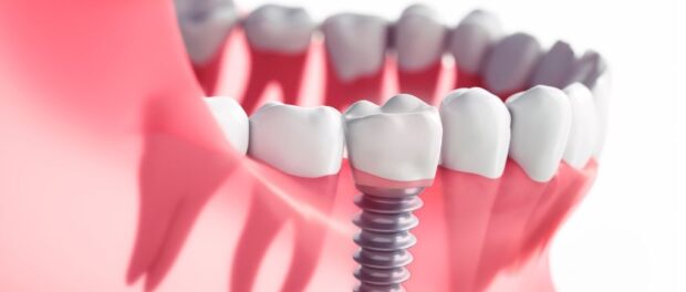 Dental Implants in Scottsdale