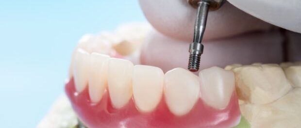 Dental Implants in Corpus Christi | Tide Dental